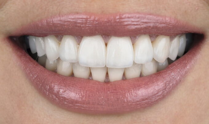 After -Cavendish Dental Care